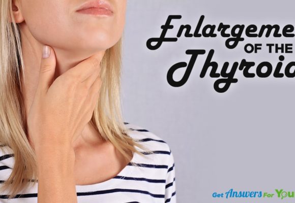 enlargement-of-thyroid